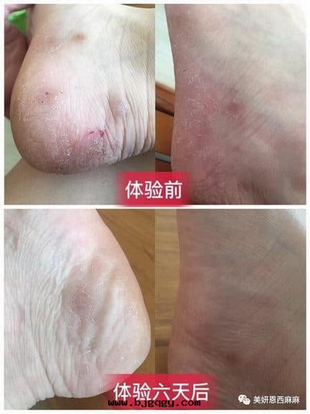 RootSense根元(yuán)智能(néng)鞋(xié)櫃-Footies-有(yǒu)效緩解(jiě)腳(jiǎo)气对(duì)比图(tú)